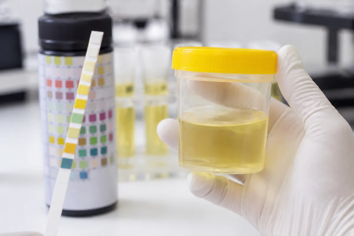 Urinalysis Testing